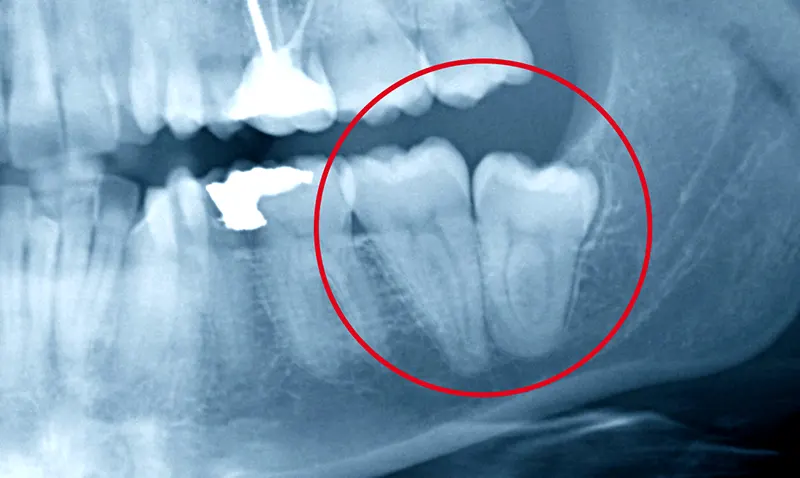 Ankiloze Diş Nedir? Ankiloze Diş Çekimi ve Tedavisi