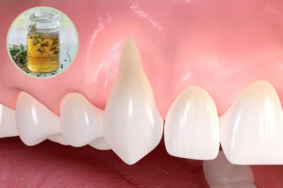 Diş Eti Çekilmesinde Kekik Suyu Kullananlar