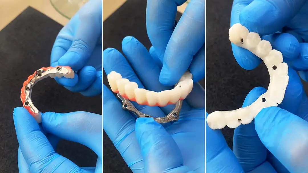 Titanyum Bar İle Zirkonyum Diş Kaplama implant üstü sabit protezlerde titanyum bar ile zirkonyum köprü kullanımı